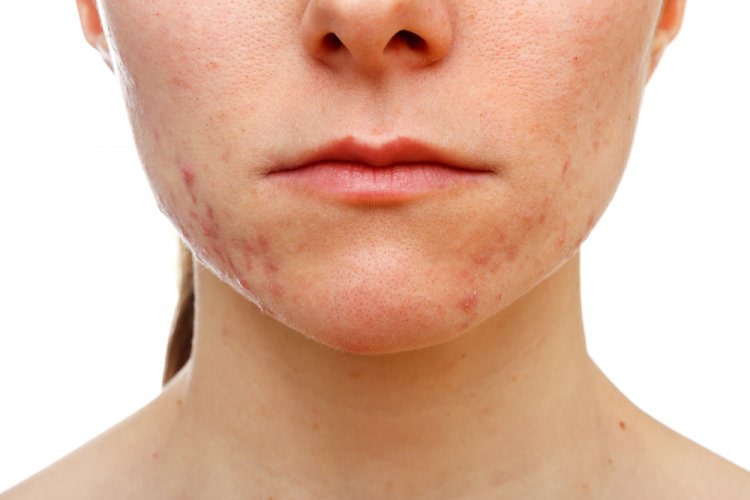 acne-min